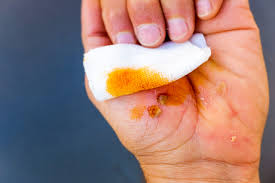 A Simple Home Remedy That May Help When First Aid Is Not Available After an Injury