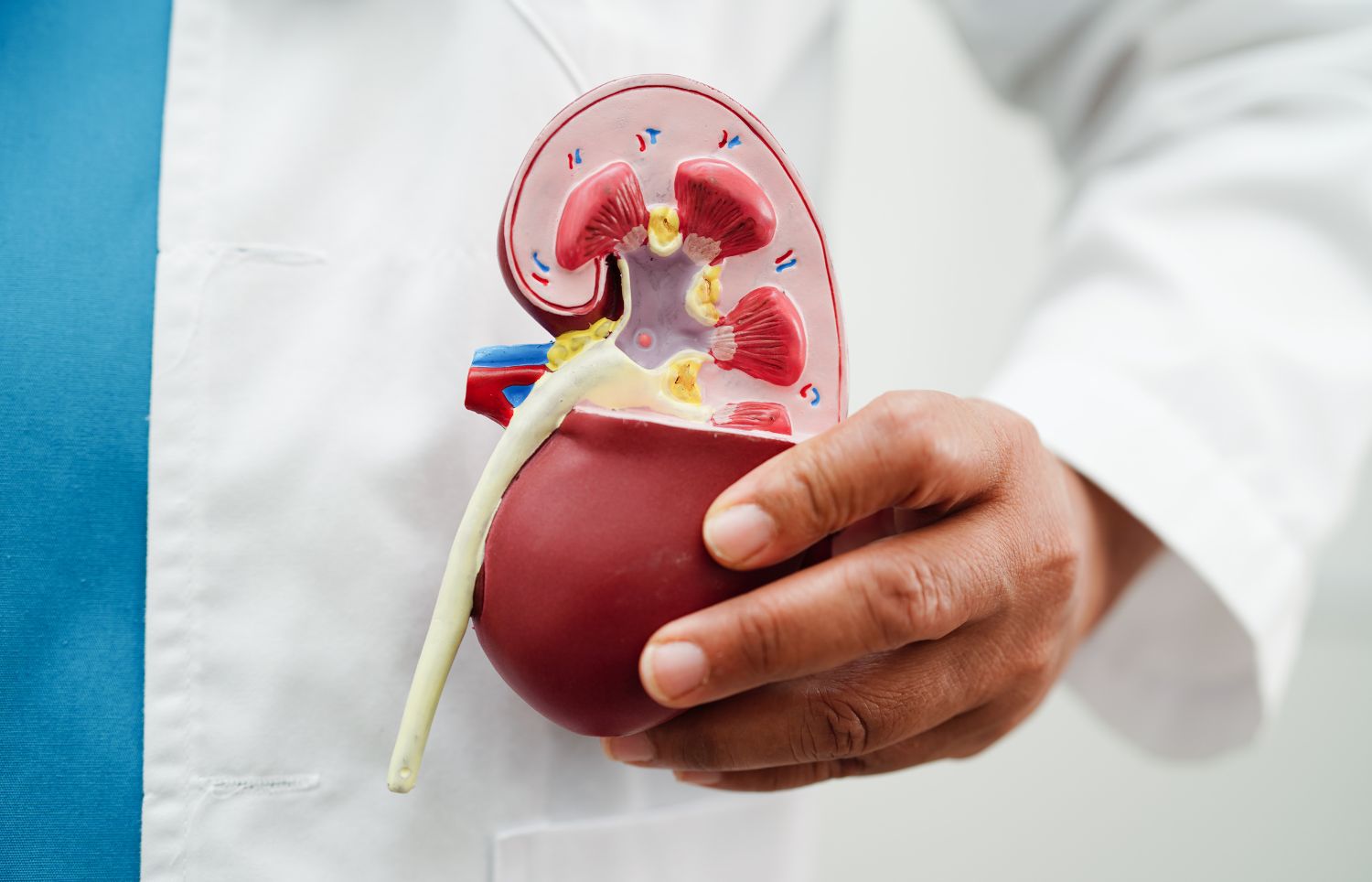 Why Kidney Stones Are Increasing Among Young People: Experts Explain